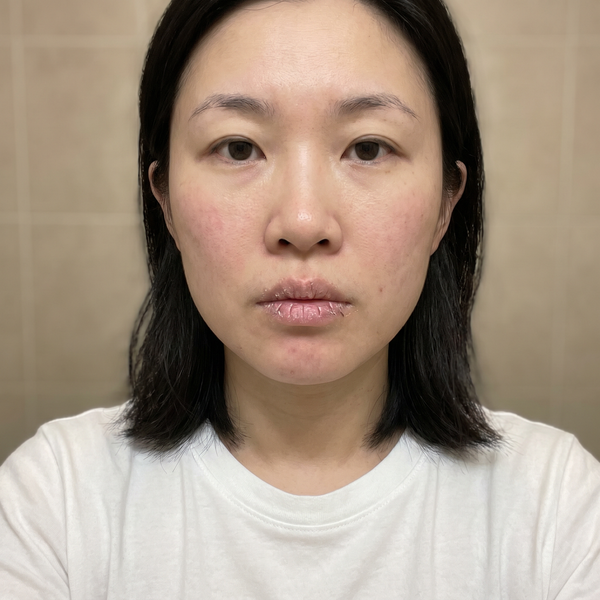Before — Mei, 32